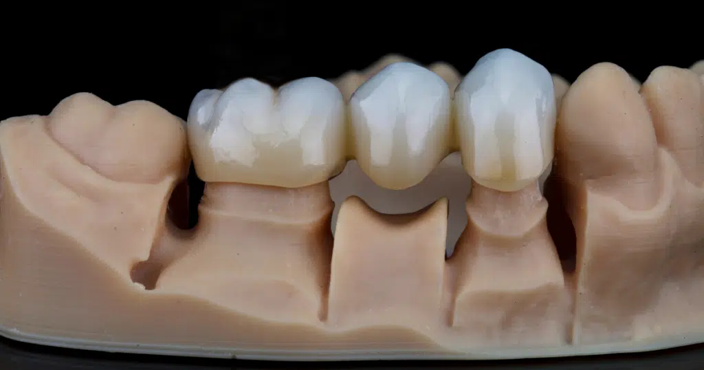 Dental Bridges - Kettering - featured image