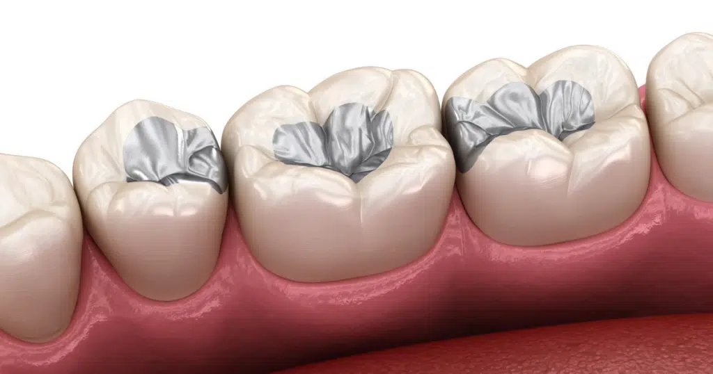 Dental Fillings - Kettering - featured image