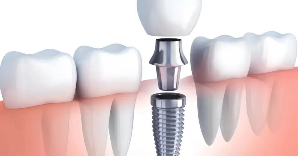Dental Implants - Kettering - featured image