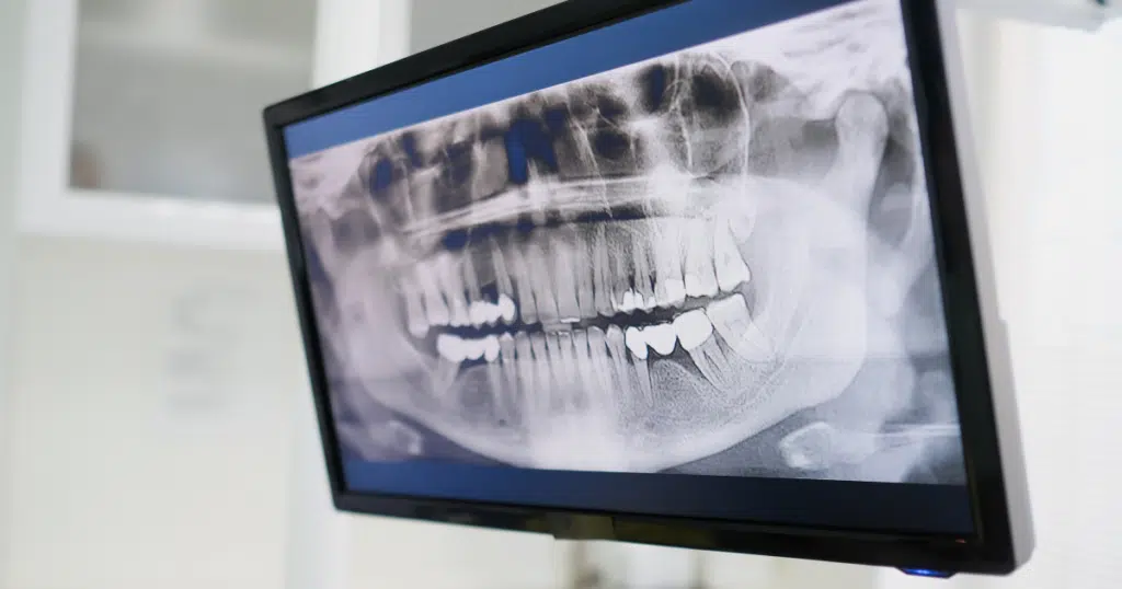 Digital X-Rays - Kettering - featured image