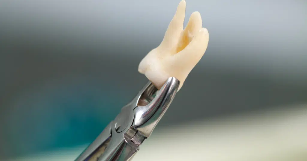 Extractions - Kettering - featured image