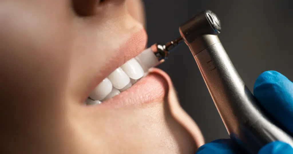 Routine Cleanings & Exams - Kettering - featured image