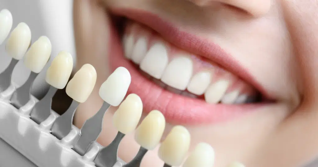Teeth Whitening - Kettering - featured image