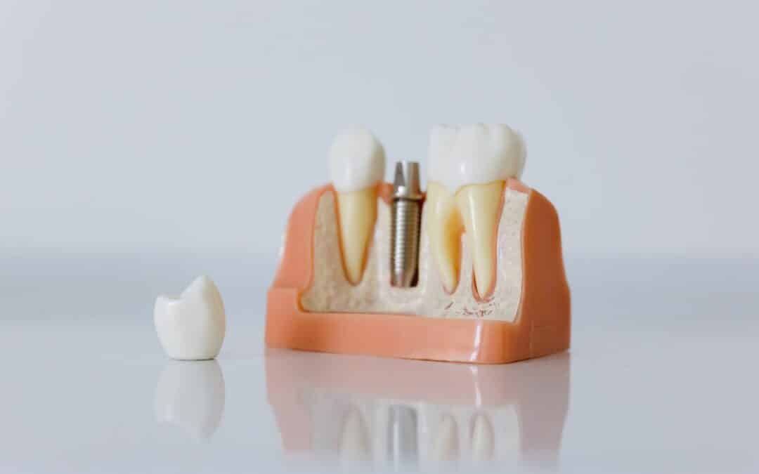 5 Surprising Ways Dental Implants Can Improve Your Health